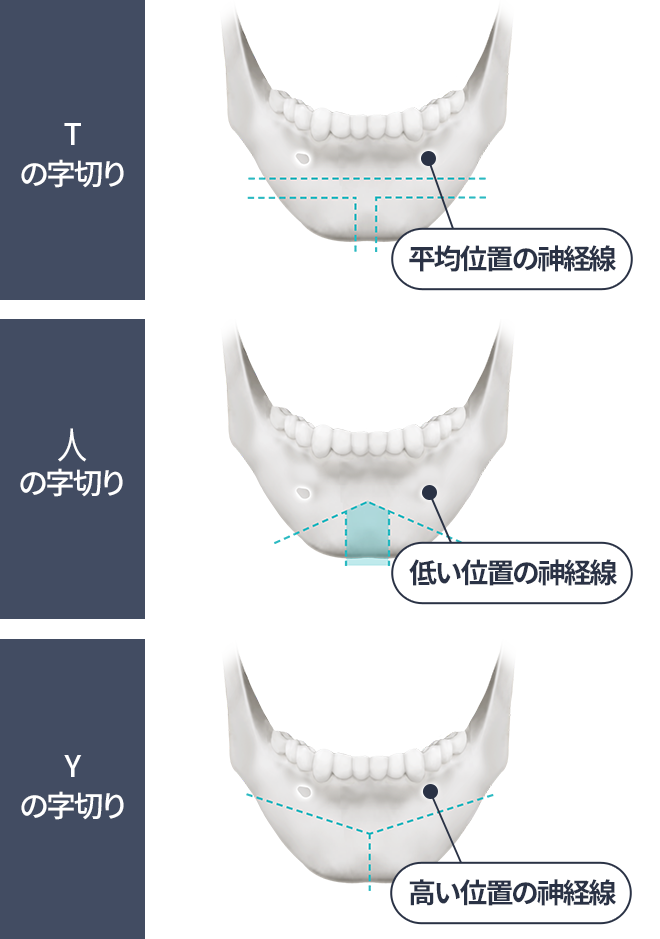  Т-остеотомия, ㅅ(Шиот) остеотомия, Y-остеотомия
