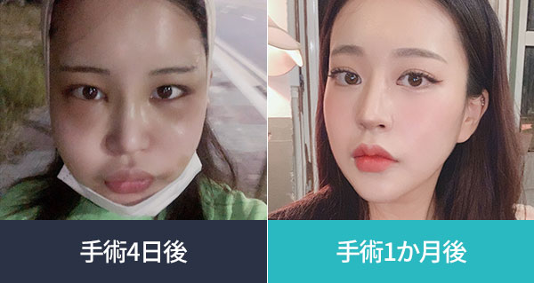 수술 후 4일 - > 수술 후 1개월