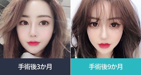 수술 후 3개월 -> 수술 후 9개월